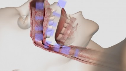 Sleep apnea - Animated medical animation by Aarons CGI
